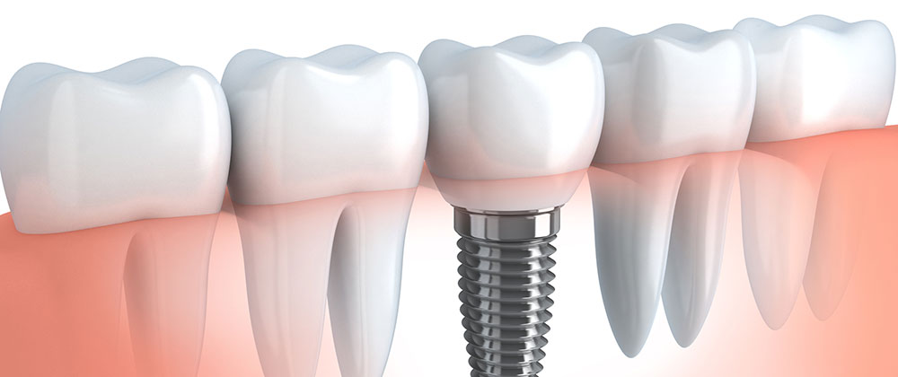 Florida Dental Implant Injury