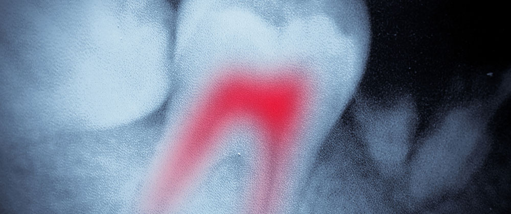 Florida Root Canal Malpractice